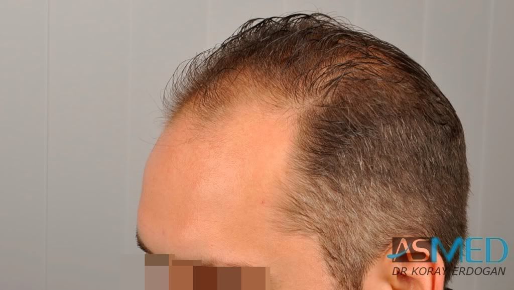 I prodotti raccomandati a una psoriasi di malattia